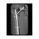 x-bolt femoral nail.jpg